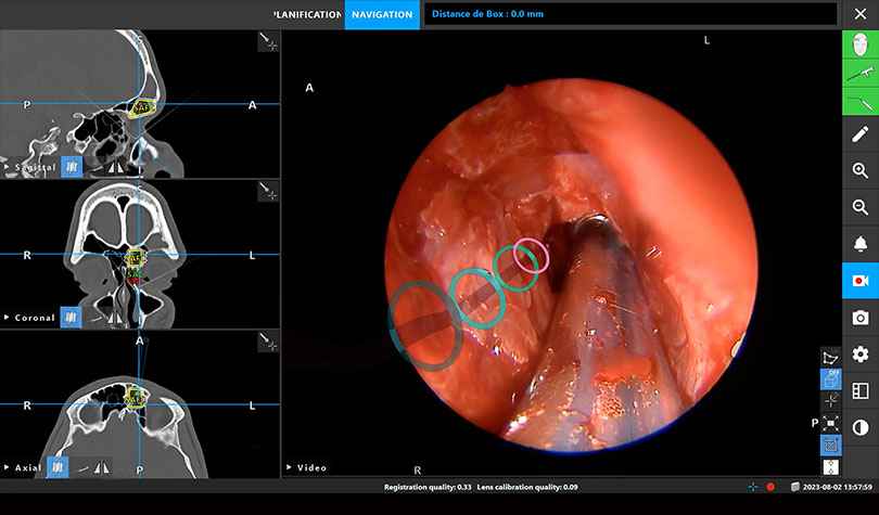 Un progrès majeur grâce à la réalité étendue